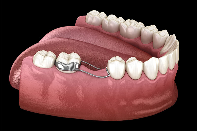 Pediatric Space Maintenance in Newton & Concord