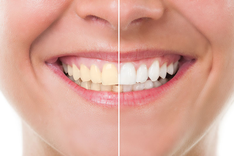 Teeth Whitening in Newton & Concord